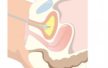 Selbstkatheterismus: Tipps und Tricks - Hilfe bei Blasenstörungen
