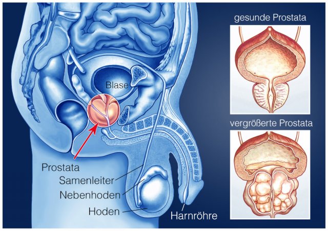 Schematische Darstellung des Genitaltraktes beim Mann mit vergrösserter Prostata
