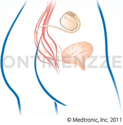 Sakralen Neuromodulation